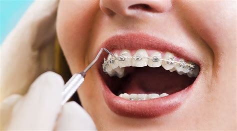 ortodoncia brackets metalicos y consulta gratis|what are brackets in braces.